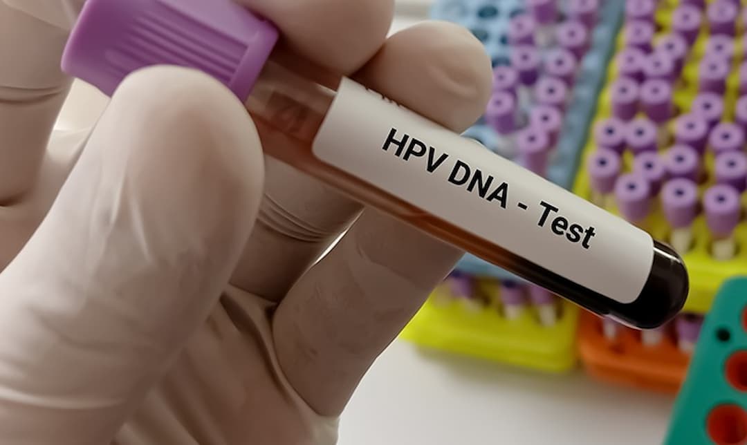 Xét nghiệm HPV PCR: