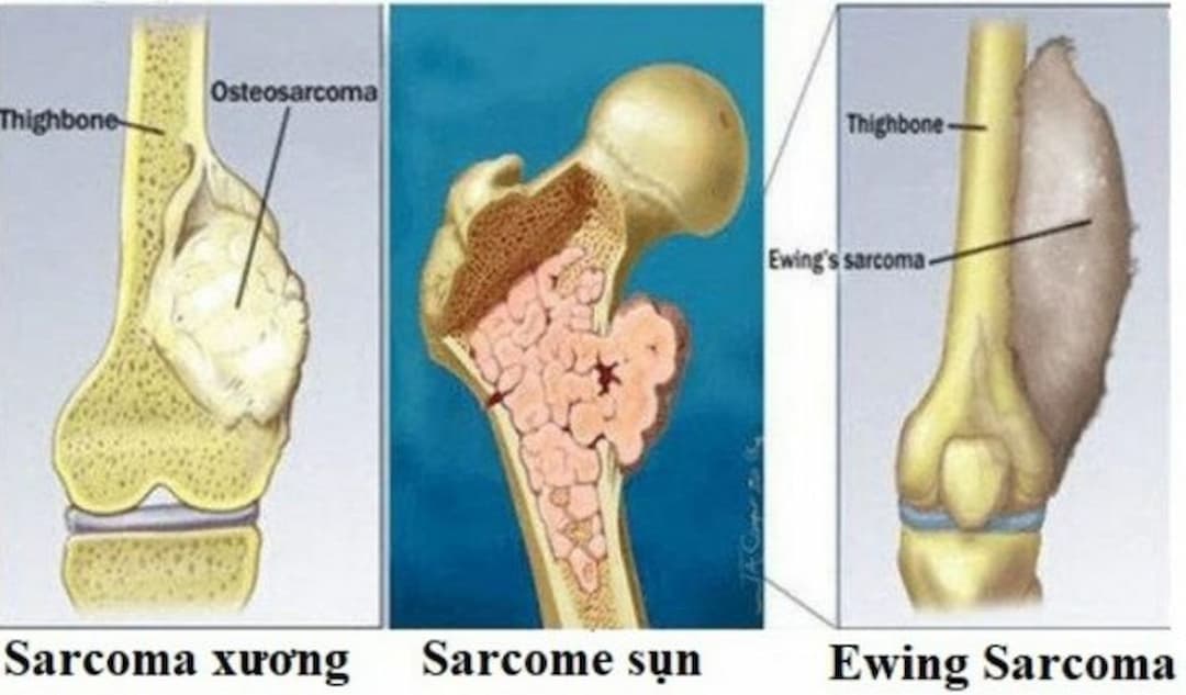 Sarcoma Xương