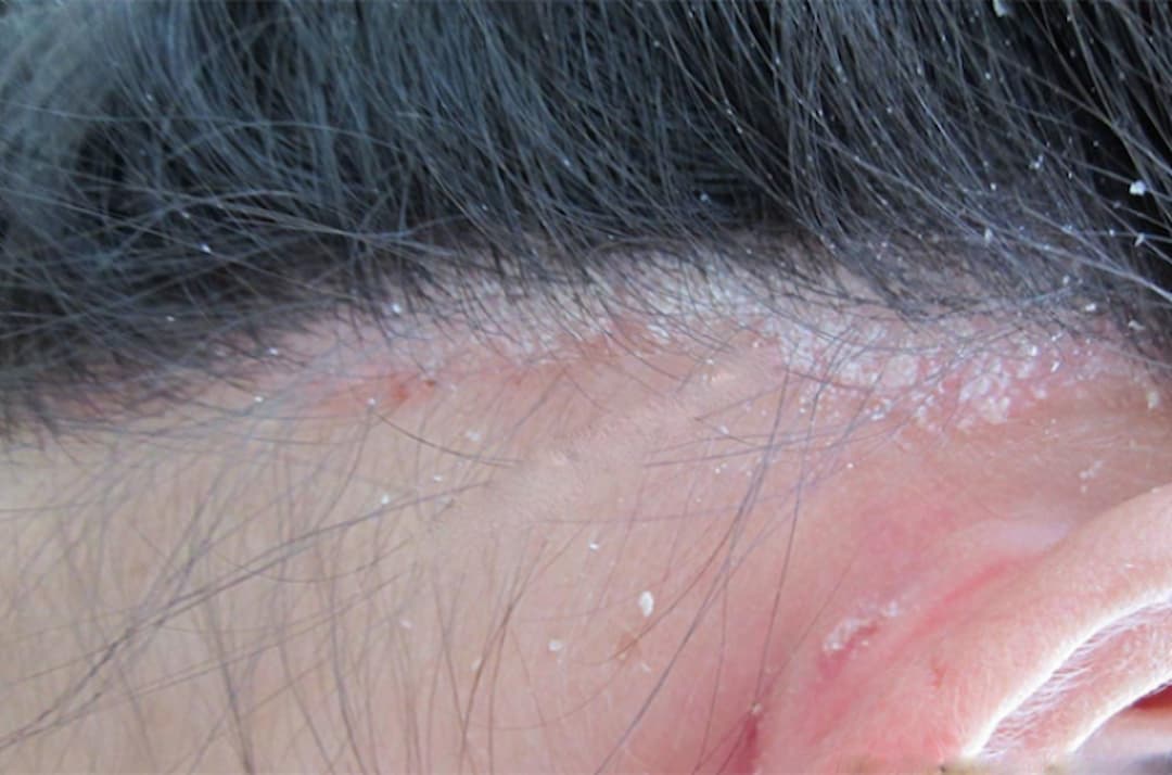 Bệnh vẩy nến da đầu có lây không có điều trị được không?