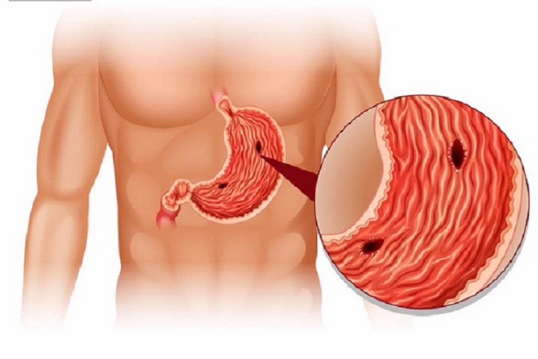 Thủng dạ dày khiến dịch tiêu hóa tràn vào ổ bụng gây viêm nhiễm và hoại tử