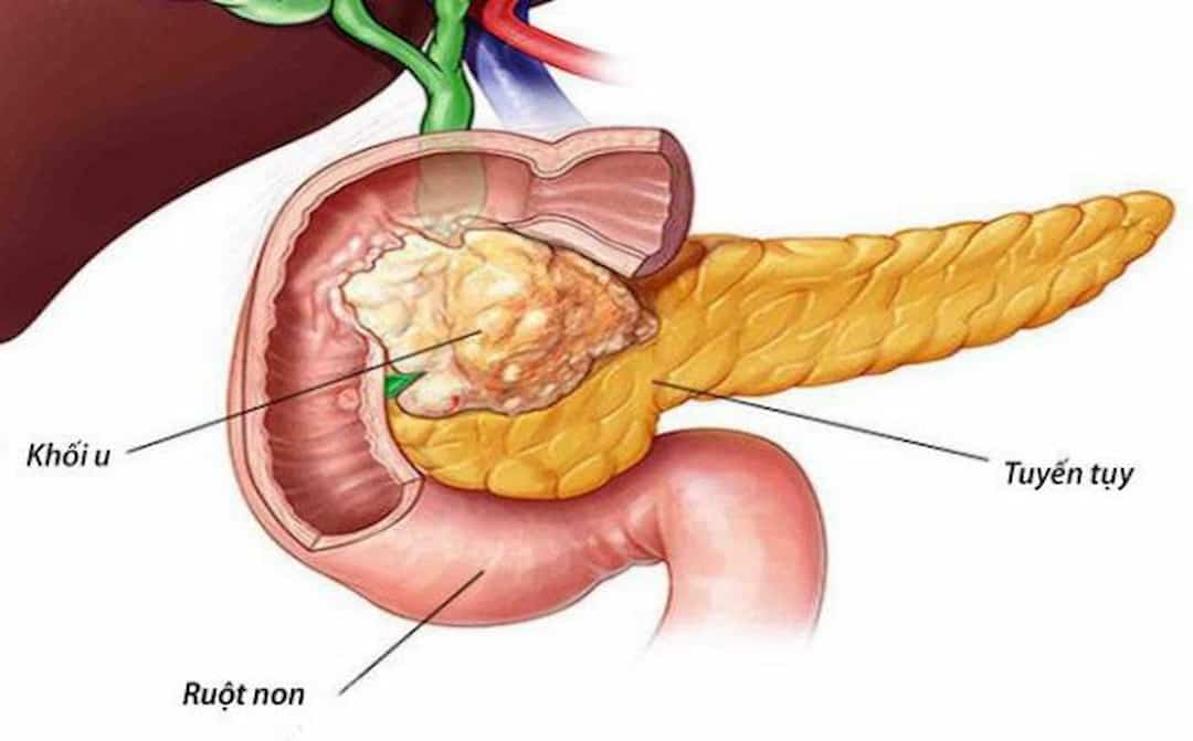 Hình ảnh khối u tuyến tụy xâm lấn