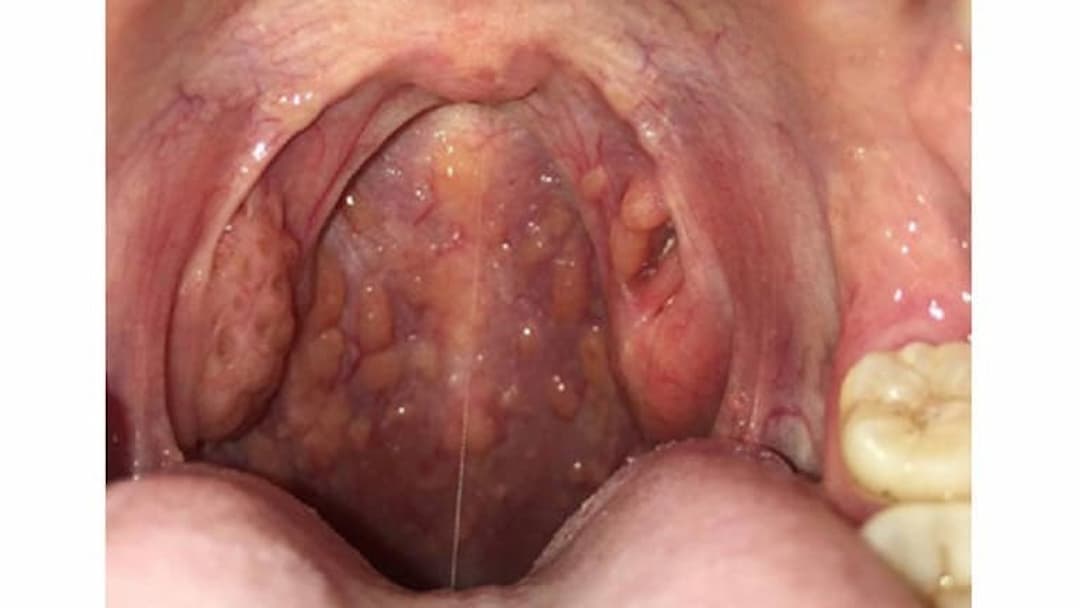 Nổi hạt trong họng, vòm họng là bị gì, có phải ung thư?