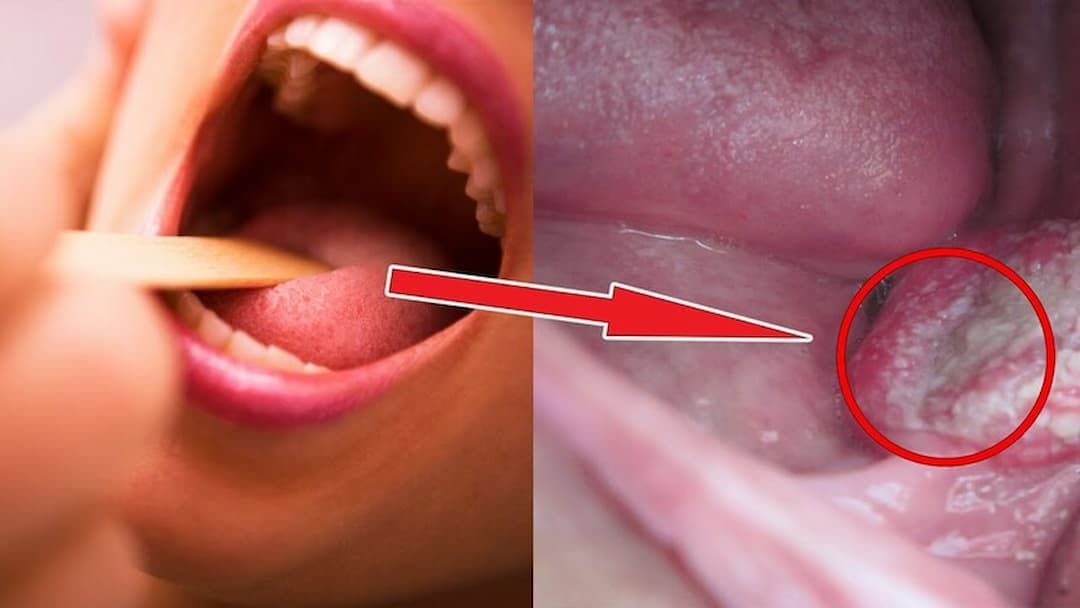 Chẩn đoán ung thư vòm họng thế nào?