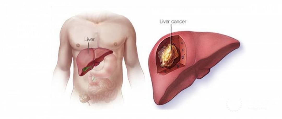 Bệnh ung thư gan có khả năng lây lan không?