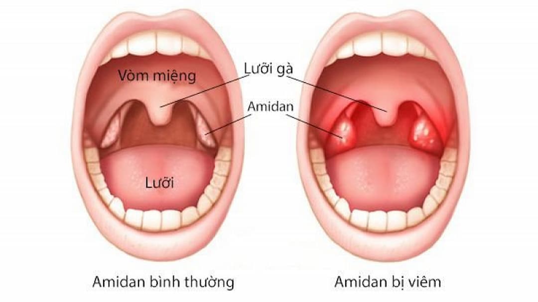 Viêm amidan thường có dấu hiệu đau họng